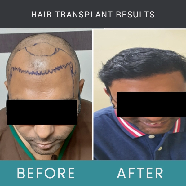 Before / After Image of Hair Transplant