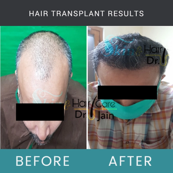 Before / After Image of Hair Transplant