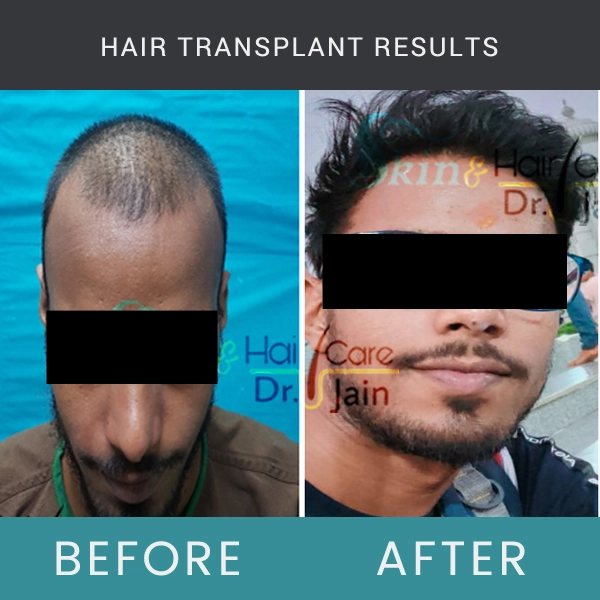 Before / After Image of Hair Transplant