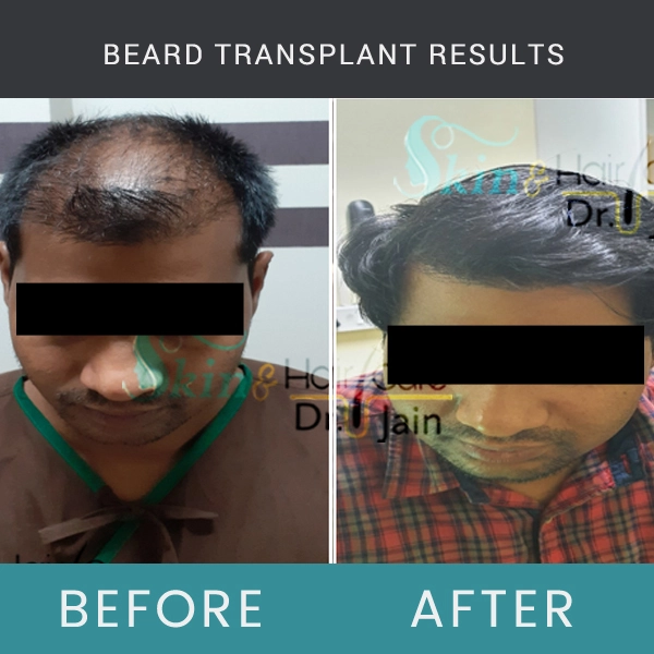 Before / After Image of Beard Transplant