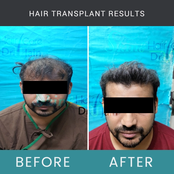 Before / After Image of Hair Transplant