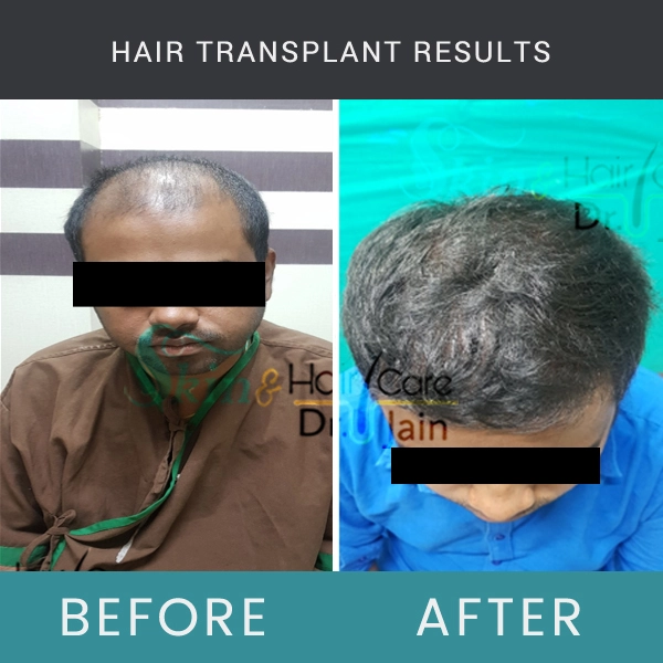 Before / After Image of Hair Transplant